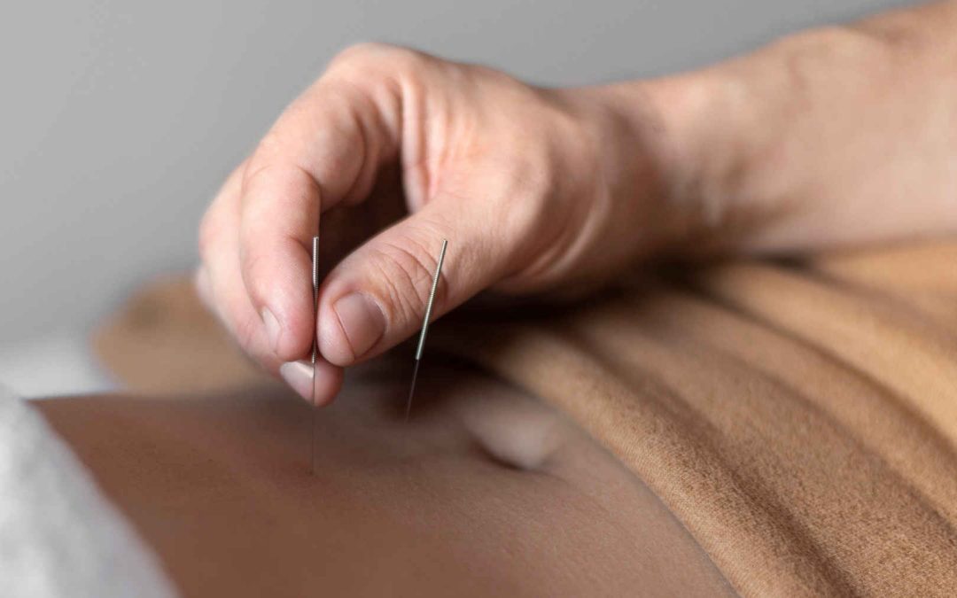 Wat is Dry Needling?